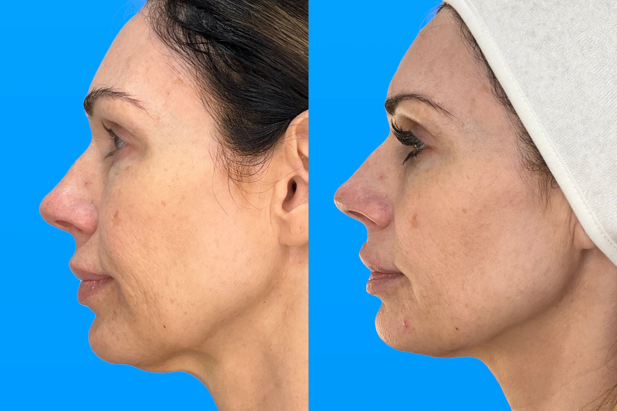 XERF™ Structural Skin Tightening in Laguna Hills, CA