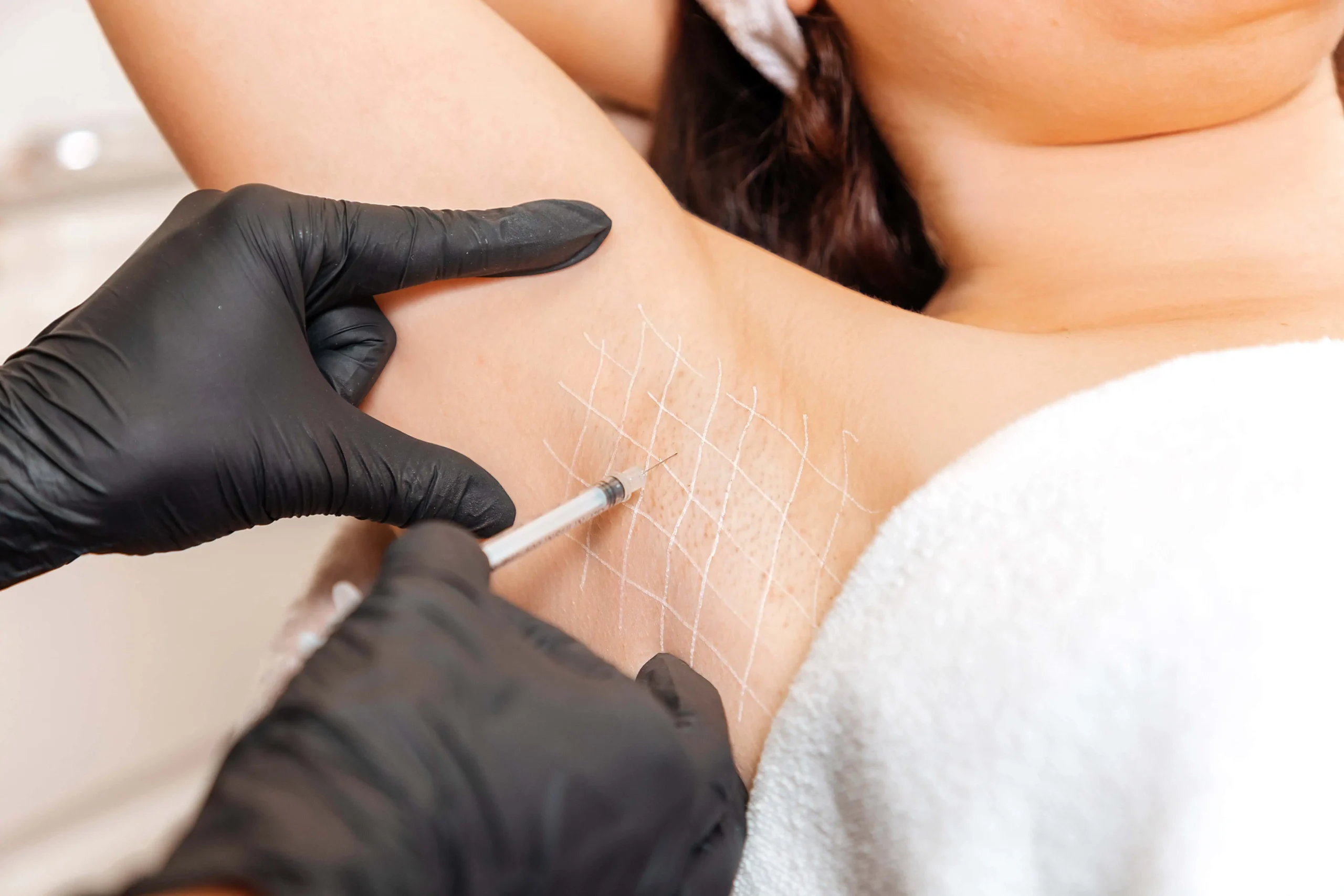 Neurotoxin Injections for Hyperhidrosis in Laguna Hills, CA